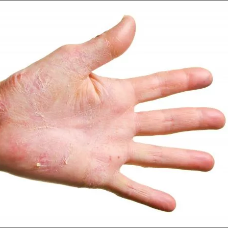 Модуль №4 Заболевания кожи рук и ногтей
